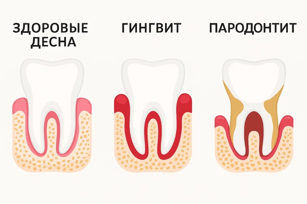 Пародонтит