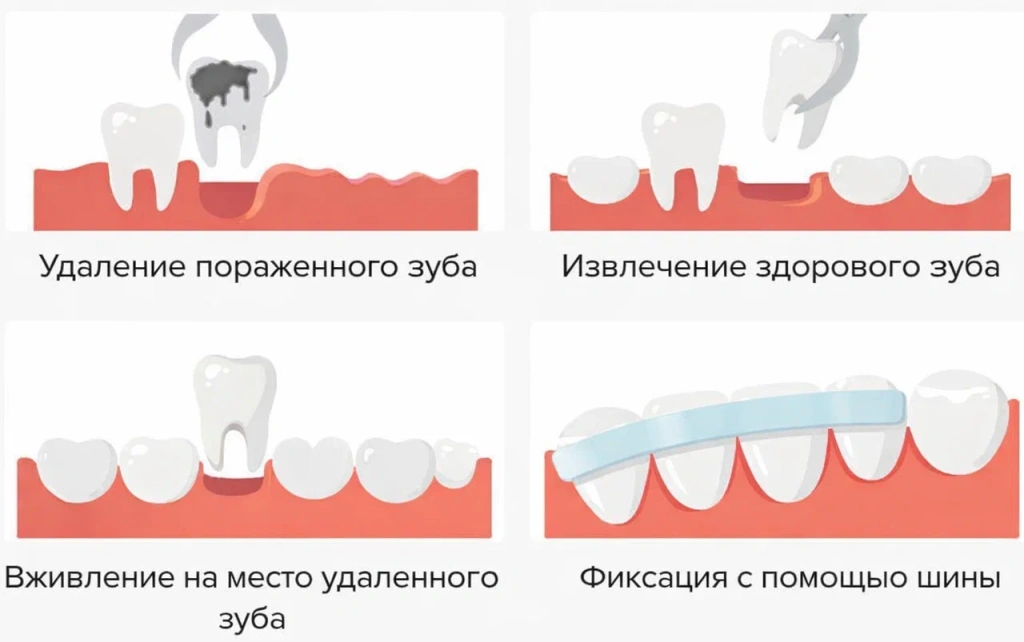 provedenie autotransplantacii zuba